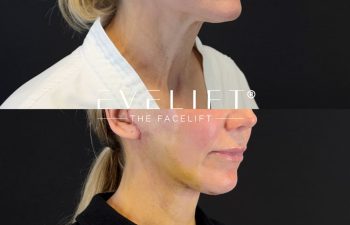 female patient before and after EVELIFT®