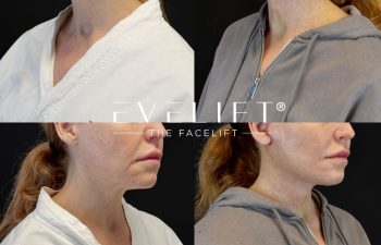 female patient before and after EVELIFT®