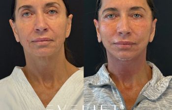 female patient before and after EVELIFT®
