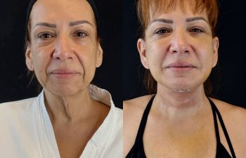 female patient before and after EVELIFT®