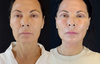 female patient before and after EVELIFT®