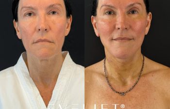female patient before and after EVELIFT®