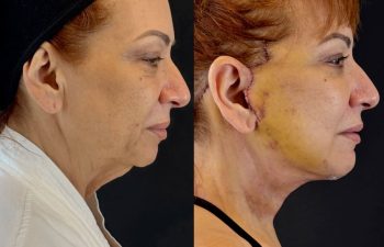 female patient before and after EVELIFT®