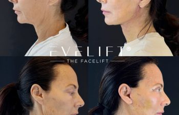 female patient before and after EVELIFT®
