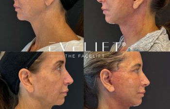 female patient before and after EVELIFT®
