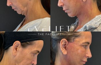 female patient before and after EVELIFT®