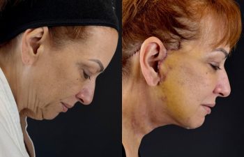 female patient before and after EVELIFT®