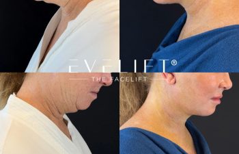 female patient before and after EVELIFT®