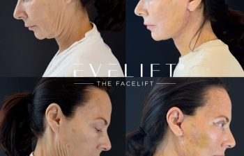 female patient before and after EVELIFT®