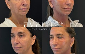 female patient before and after EVELIFT®