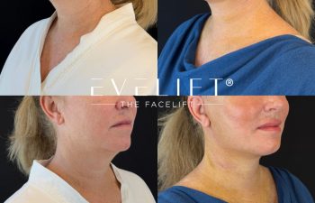 female patient before and after EVELIFT®