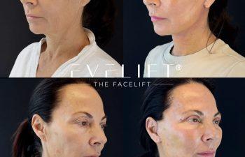 female patient before and after EVELIFT®