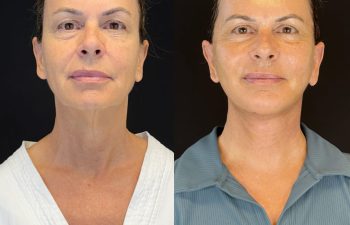 female patient before and after EVELIFT®