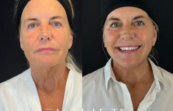female patient before and after EVELIFT®
