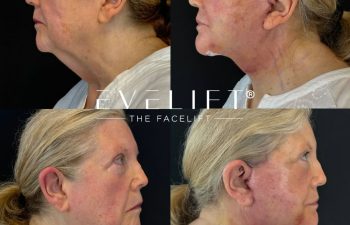 female patient before and after EVELIFT®
