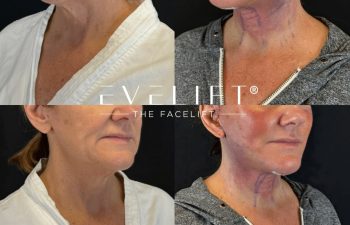 female patient before and after EVELIFT®