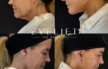 female patient before and after EVELIFT®