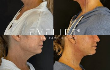 female patient before and after EVELIFT®