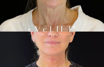 female patient before and after EVELIFT®
