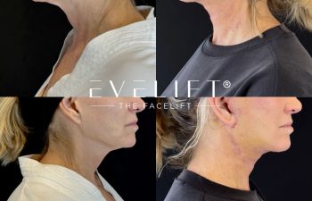 female patient before and after EVELIFT®
