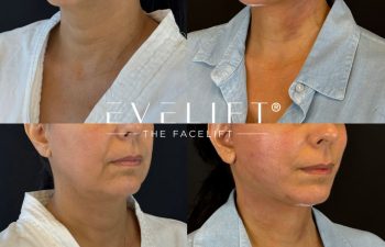 female patient before and after EVELIFT®