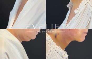 female patient before and after EVELIFT®