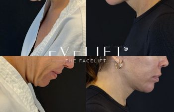 female patient before and after EVELIFT®