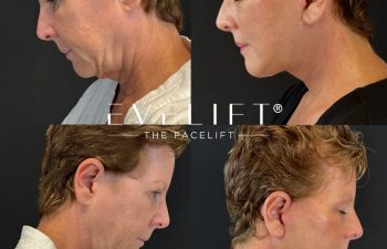 female patient before and after EVELIFT®