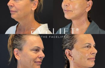 female patient before and after EVELIFT®