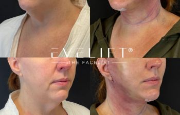 female patient before and after EVELIFT®