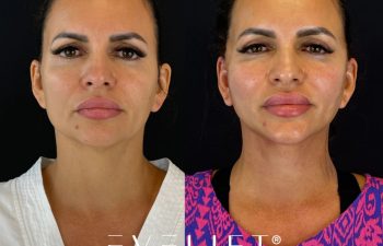 female patient before and after EVELIFT®
