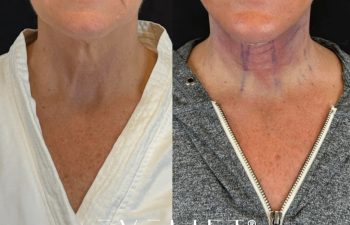 female patient before and after EVELIFT®