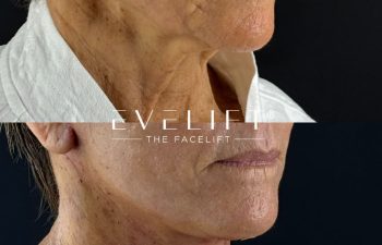 female patient before and after EVELIFT®