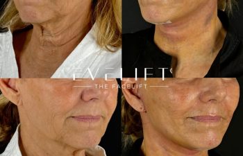 female patient before and after EVELIFT®