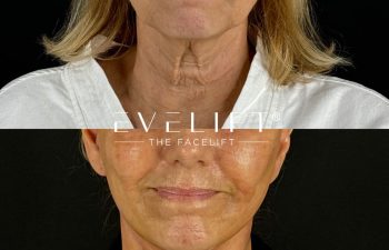 female patient before and after EVELIFT®