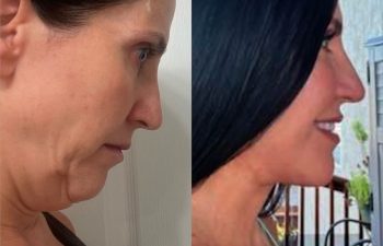 female patient before and after EVELIFT®