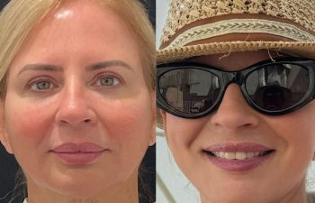 female patient before and after EVELIFT®
