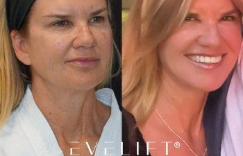 female patient before and after EVELIFT®