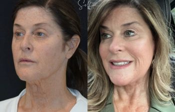 female patient before and after EVELIFT®