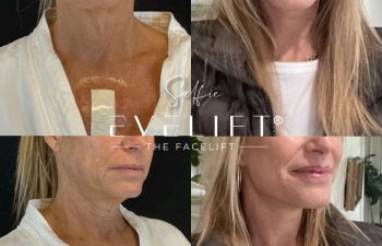 female patient before and after EVELIFT®