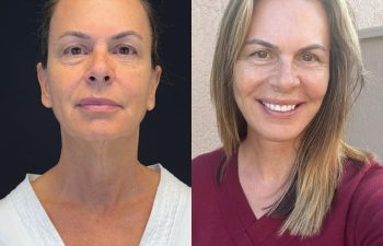 female patient before and after EVELIFT®