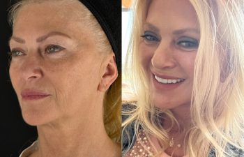 female patient before and after EVELIFT®