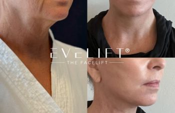 female patient before and after EVELIFT®