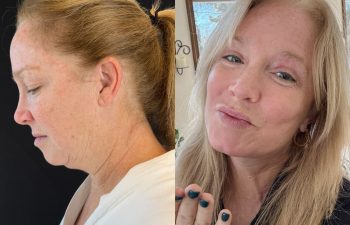 female patient before and after EVELIFT®