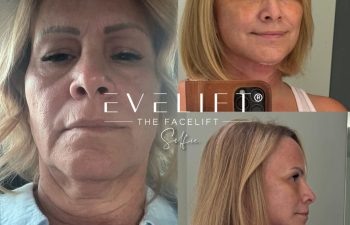 female patient before and after EVELIFT®