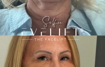 female patient before and after EVELIFT®