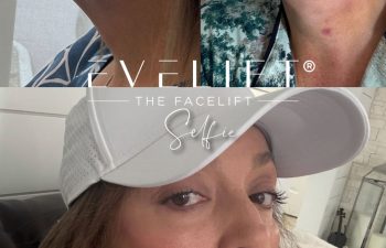 female patient before and after EVELIFT®