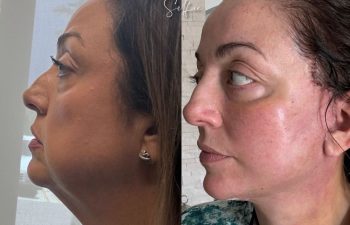 female patient before and after EVELIFT®