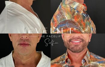 male patient before and after EVELIFT®