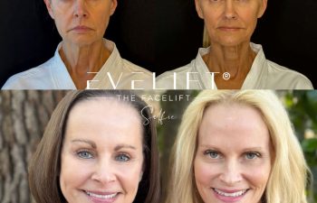 female patient before and after EVELIFT®